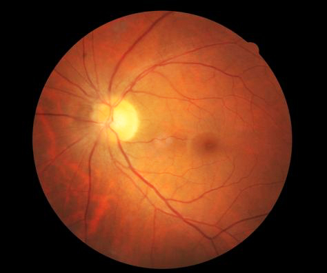 视网膜是人体唯一能看到微丝血管的组织